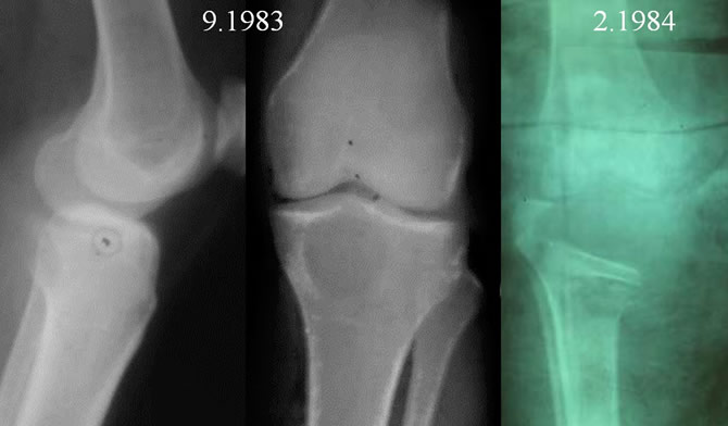 Tumeur à cellules géantes