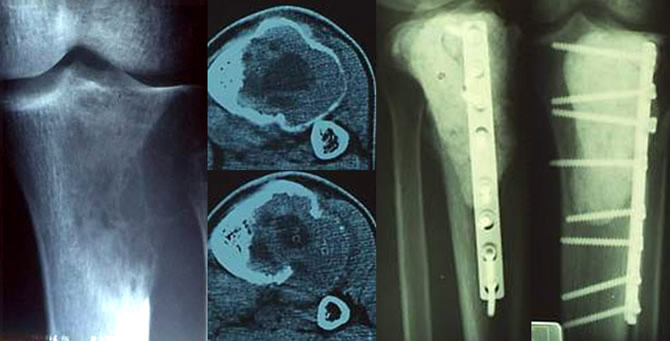 Tumeur à cellules géantes