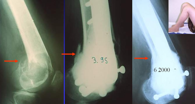 Tumeur à cellules géantes