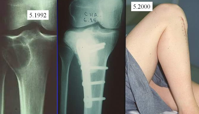 Tumeur à cellules géantes