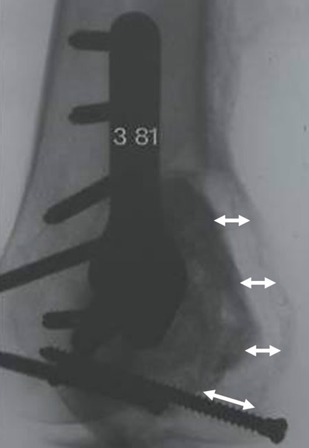 Tumeur à cellules géantes