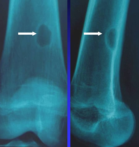 Fibromes non ossifiant