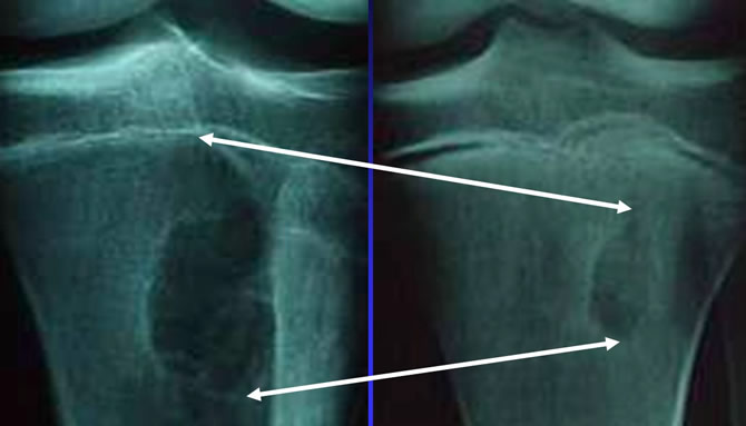 fibrome non ossifiant évolution naturelle