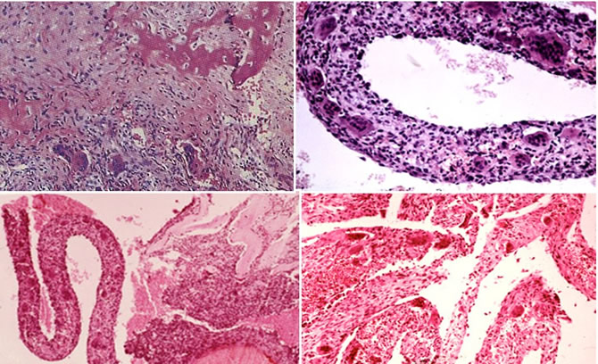 Aspects microscopiques Kystes Anévrysmaux