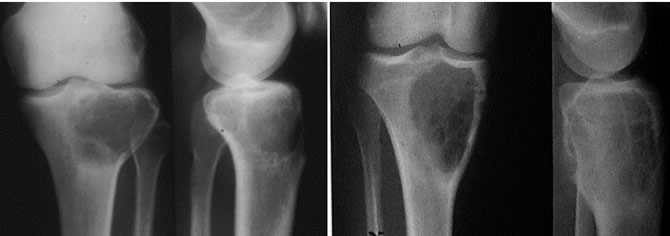 Kystes Anévrysmaux tibia