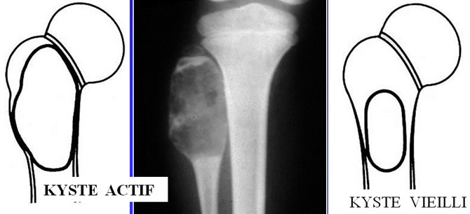 Aspect radiologique Kystes Solitaires