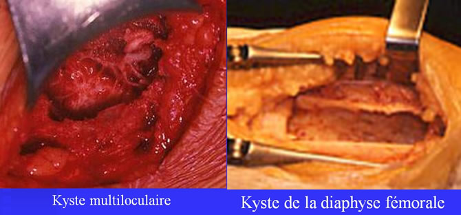 Aspect radiologique Kystes vieilli