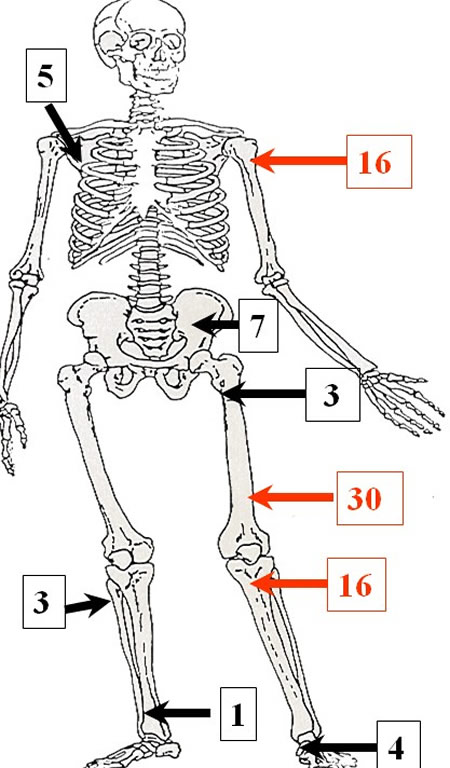 Exostoses Ostéogéniques métaphyses fertiles