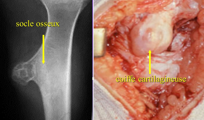 exostose ostéogénique pédiculée