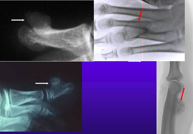 exostose ostéogénique petits os périphériques