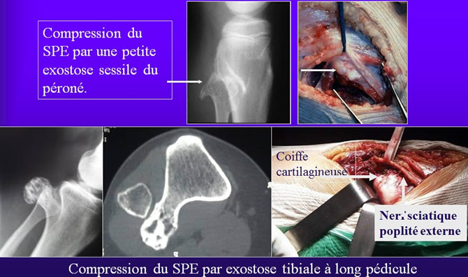 exostose ostéogénique compression tronculaire