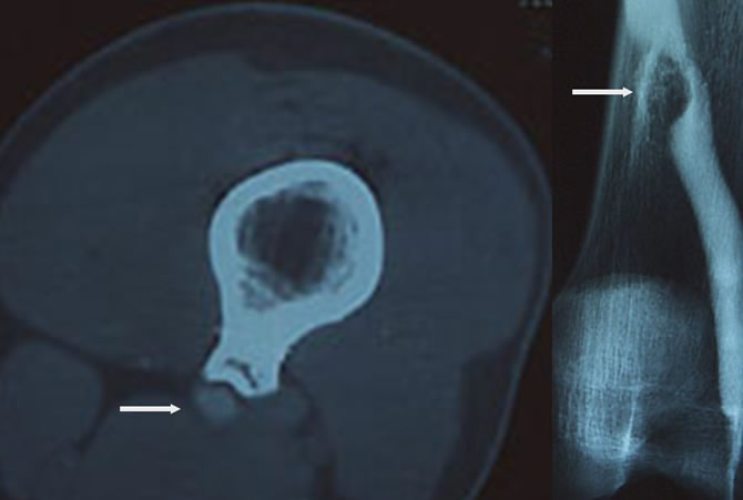 exostose ostéogénique compression veineuse