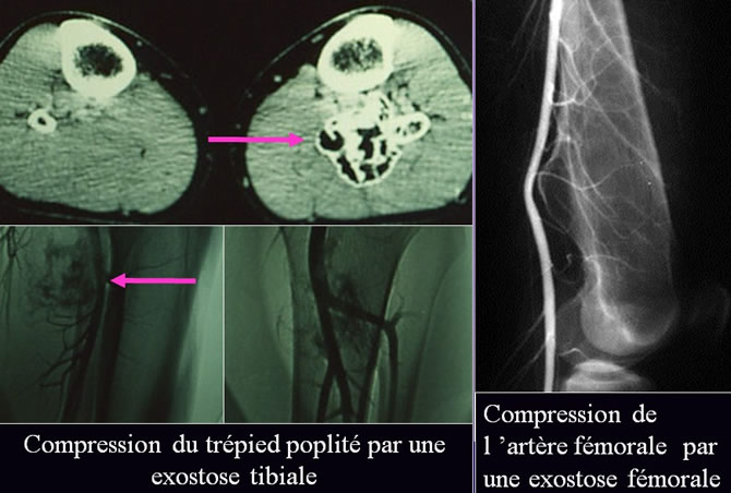 exostose ostéogénique compression artérielle