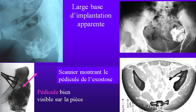 scanner  exostose ostéogénique