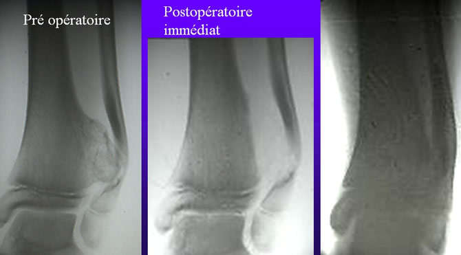 résection exostose ostéogénique