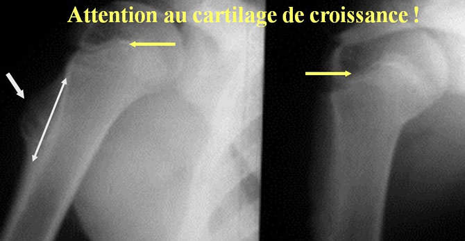 exostose ostéogénique solitaire