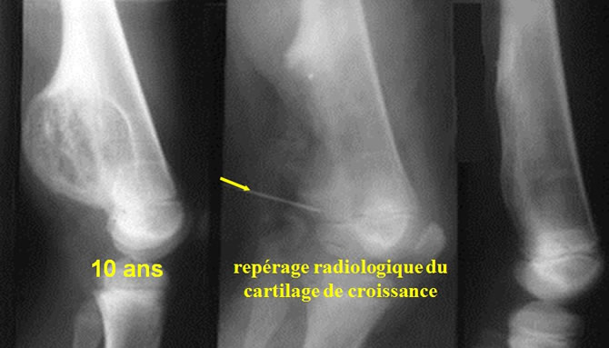 Traitement exostose ostéogénique solitaire