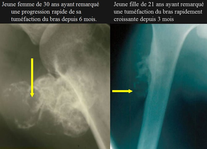 Dégénérescence exostose ostéogénique