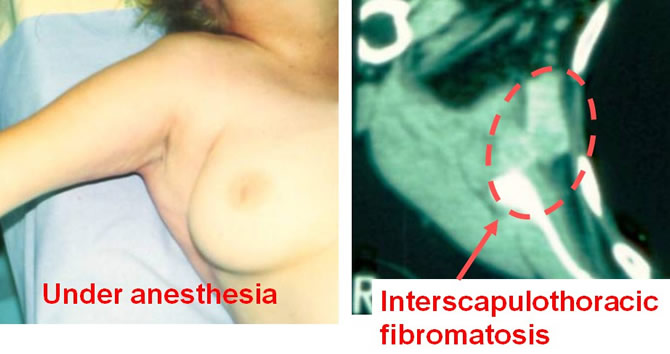 frozen scapulothoracic space