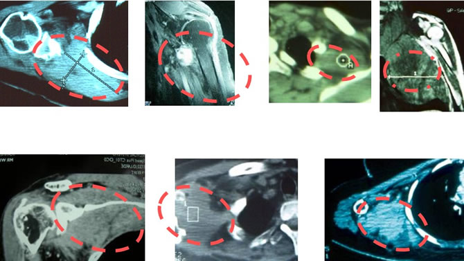 peri-scapular fibromatosis