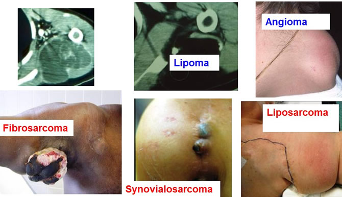 peri-scapular soft tissues tumours