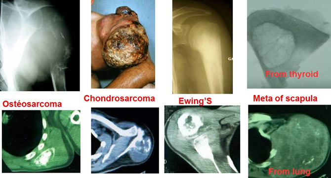 peri-scapular soft tissues tumours