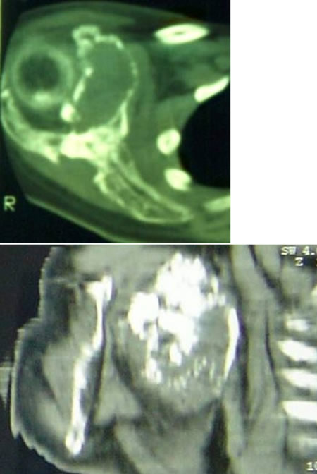peri-scapular fibromatosis
