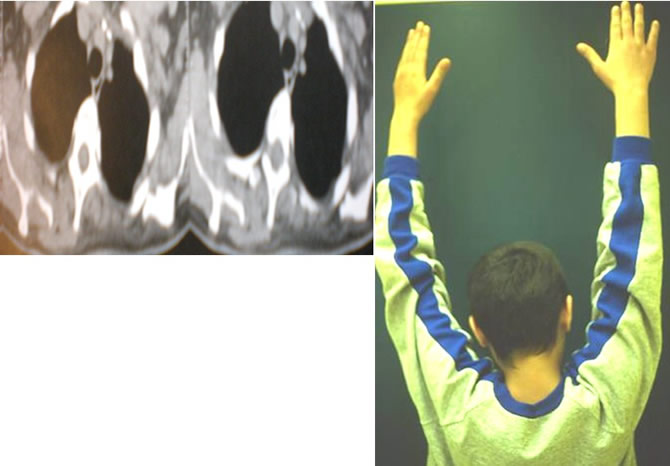 treatment of fibromatosis