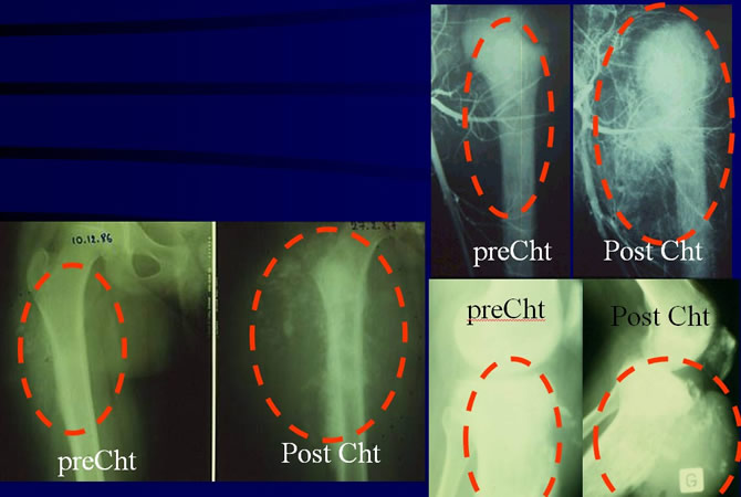 Preoperative chemotherapy