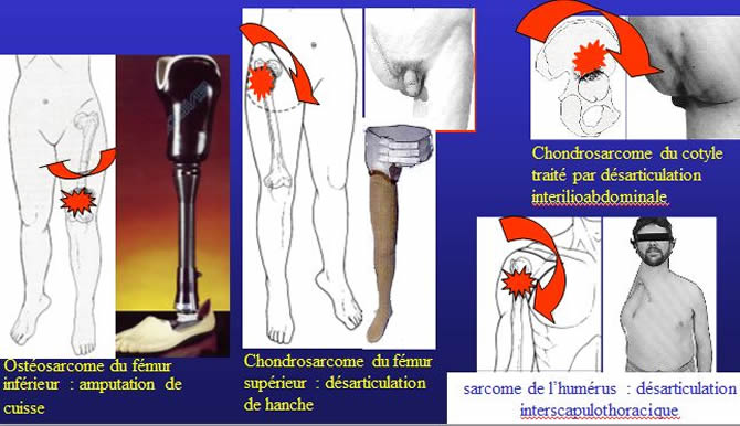 chirurgie sarcome