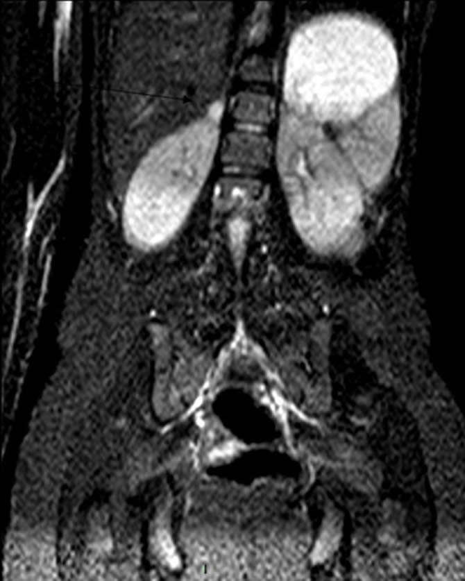 Nodule hyperintense surrénalien