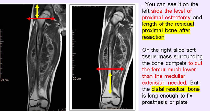 osteosarcome