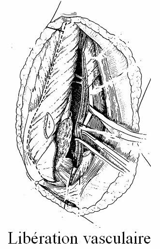 resection