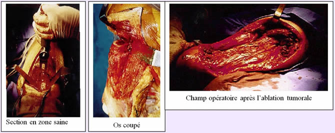 osteosarcome