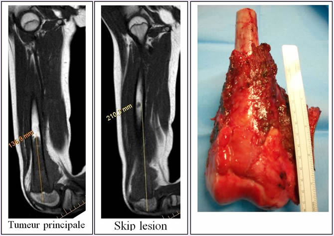 osteosarcome