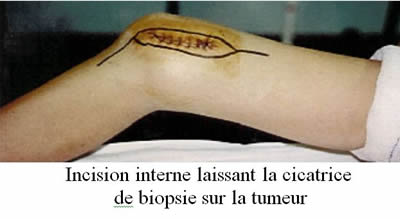 ablation tumorale