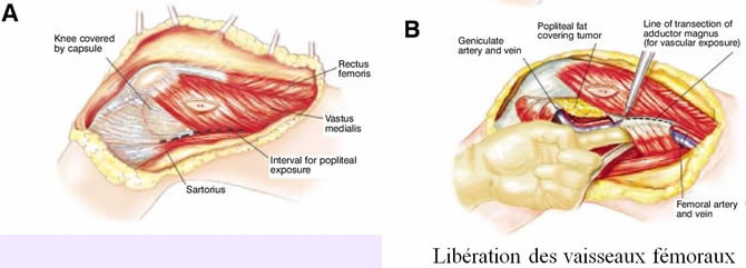 osteosarcome