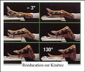 ablation tumorale