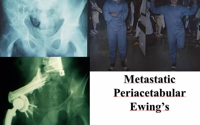Metastatic Periacetabular Ewing's