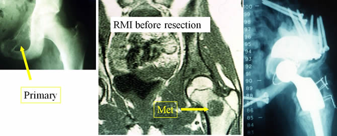 Bifocal Ewing Sarcoma