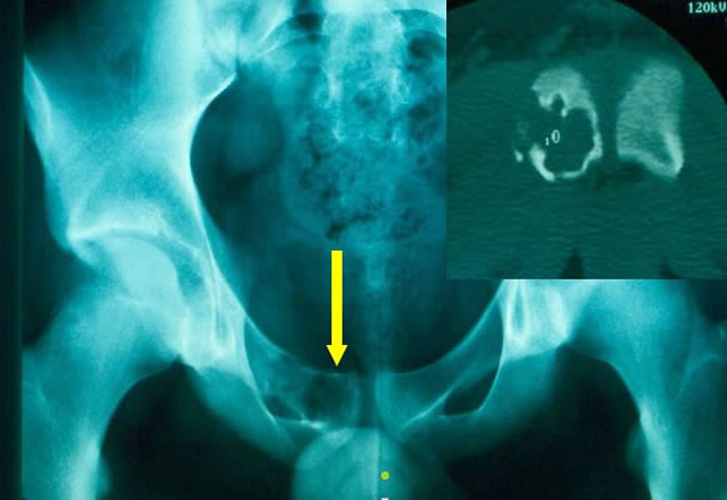 Chondrosarcoma