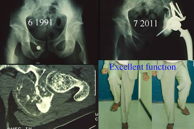 Osteosarcoma