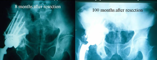 Thyroid Carcinoma