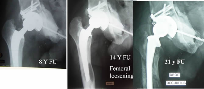 Chondrosarcoma