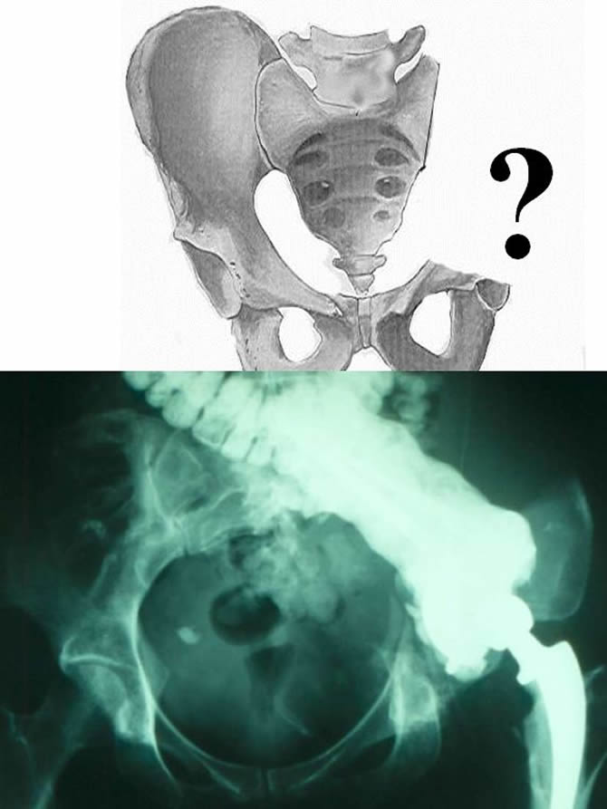 Total iliac wing and Acetablar Resection