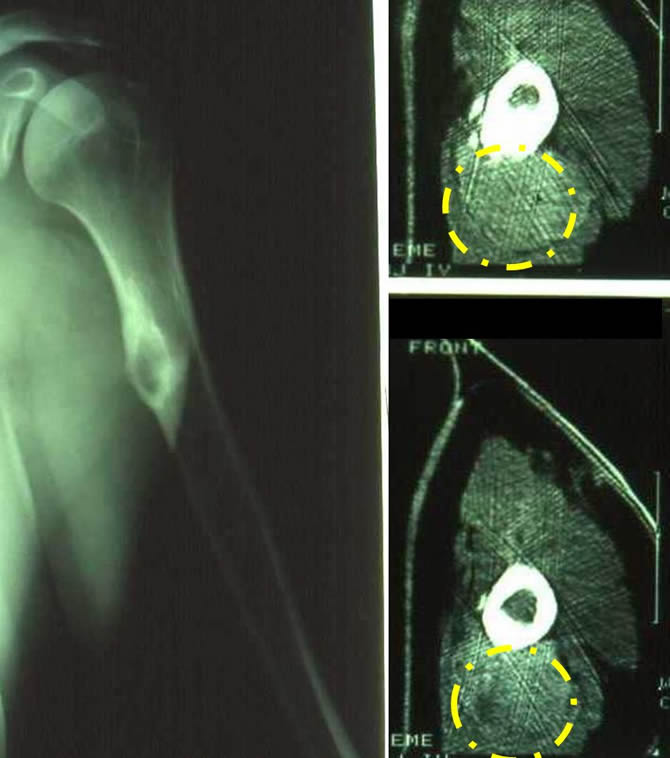 tumour invading the whole humerus