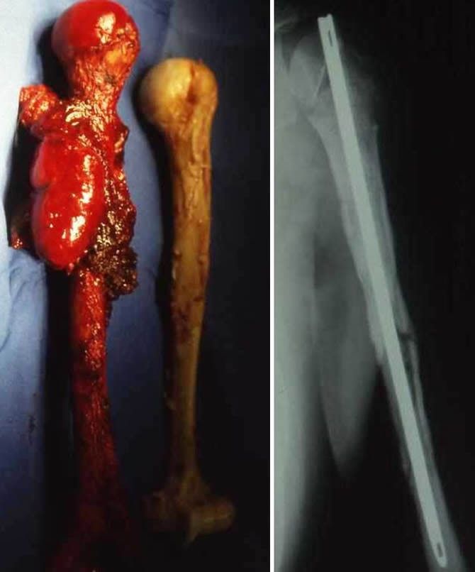 Total humeral resection