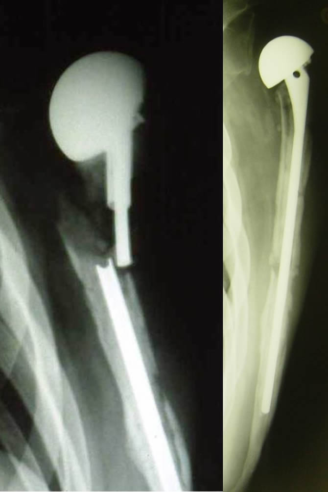 humeral prosthesis