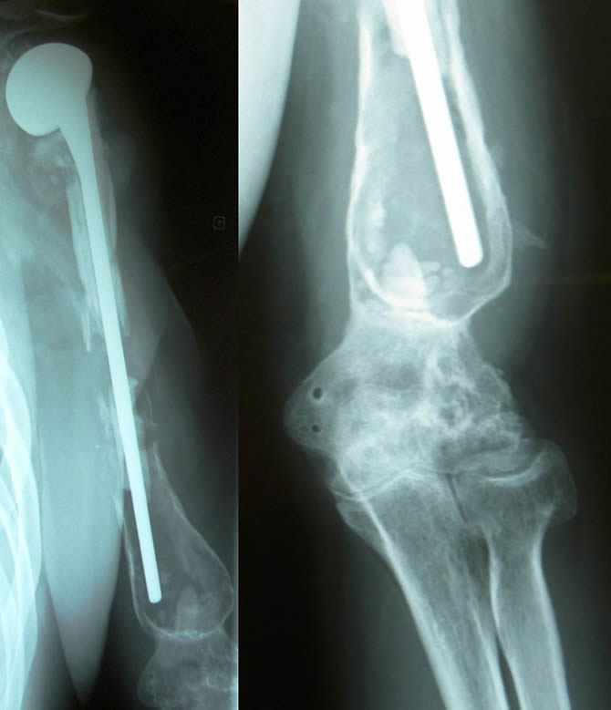 progessive resorption of allograft