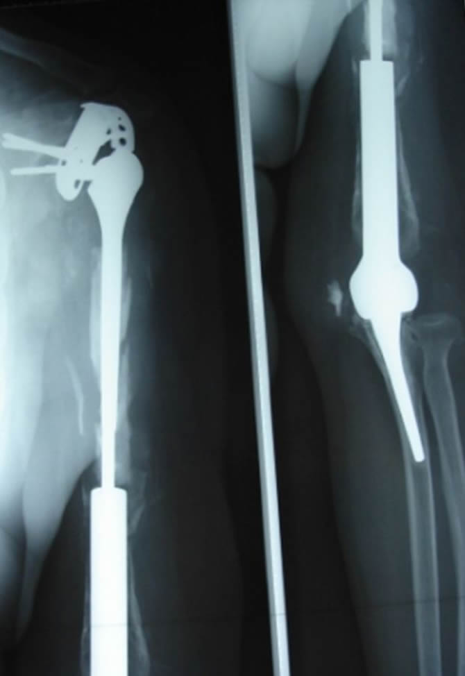 humeral prosthesis